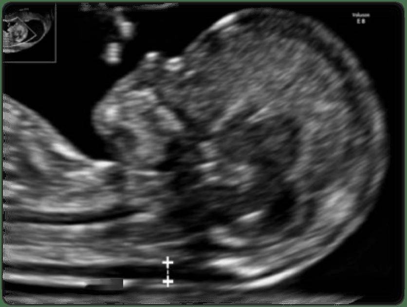 逸仙科普 | NT檢查全攻略，新手孕媽收藏不踩坑