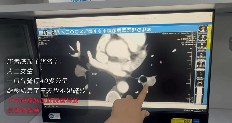 大學生連續騎行47公里險喪命 運動後出現這種症狀別輕視