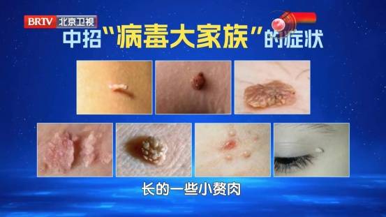 大部分女性都躲不過的病毒，反覆感染易癌變，兩個高危年齡段尤其要注意......